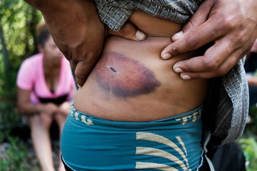 A young Honduran named Chino shows off a stab wound he received on the train tracks. Physical violence is a fact of life for Central American migrants, especially those involved in criminal activities such as extortion and human trafficking.