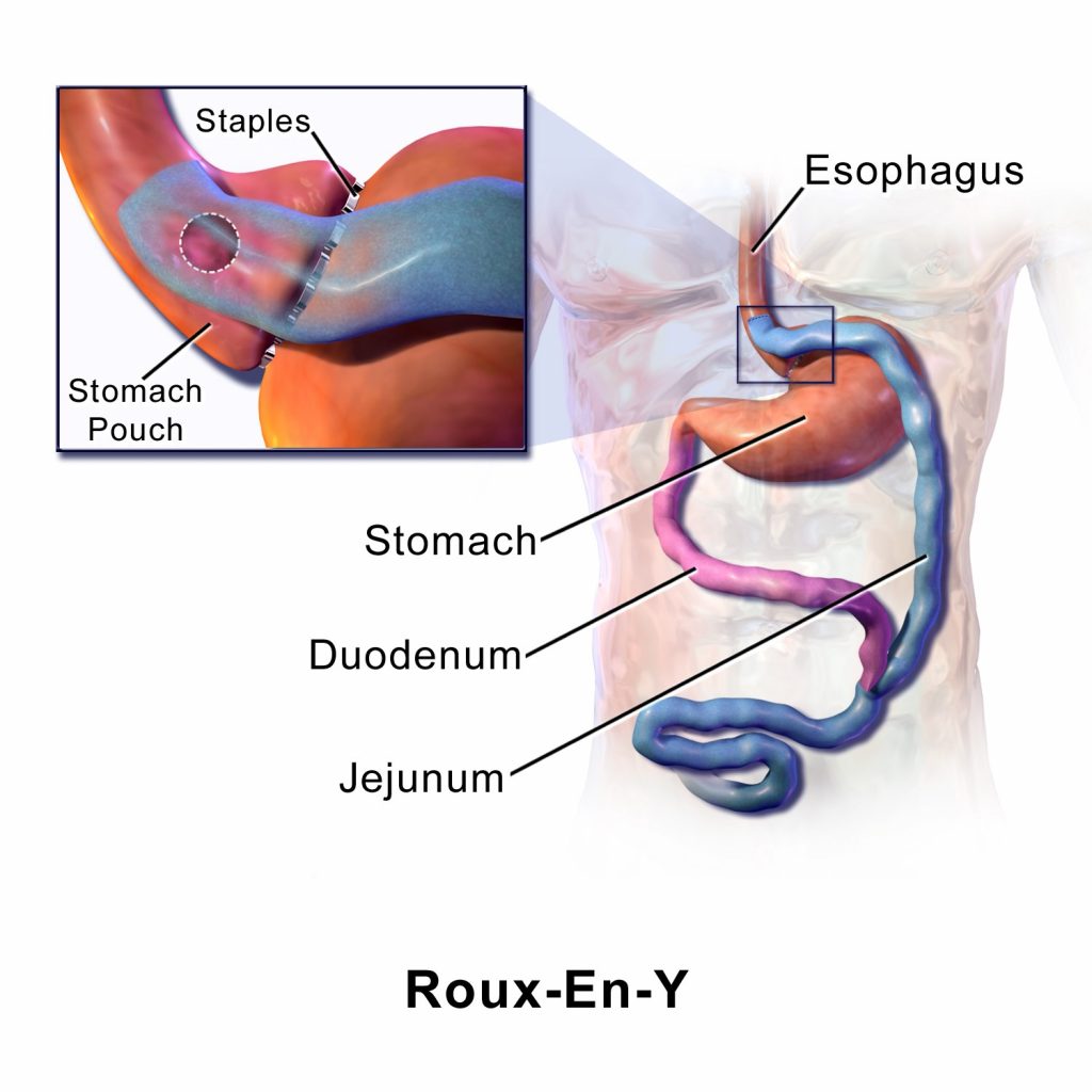 Fat stigma - Roux-en-Y gastric bypass is a common form of bariatric surgery.