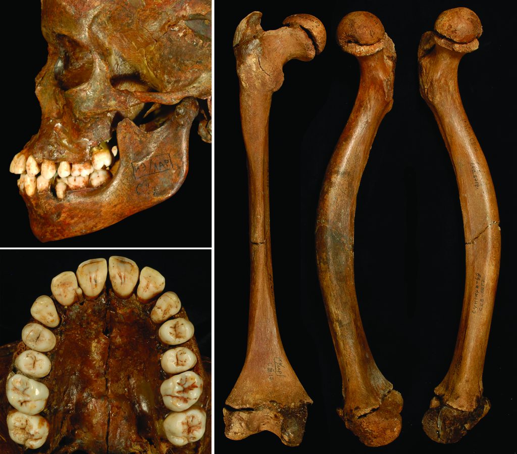 The adolescent and juvenile buried at Sunghir bear evidence of physical abnormalities: On the left, a protrusion of the upper jaw is clearly visible on the facial structure of the 12-year-old, but there are no traces of abrasion on the dentition. In the photo on the right, the femurs from the 10-year-old are shown to be curved and unusually short.