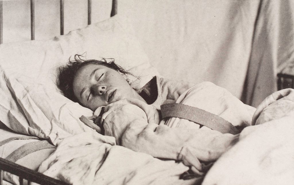 In this photo from a 19th-century mental hospital, a woman diagnosed with hysteria-induced narcolepsy sleeps wearing a straitjacket.