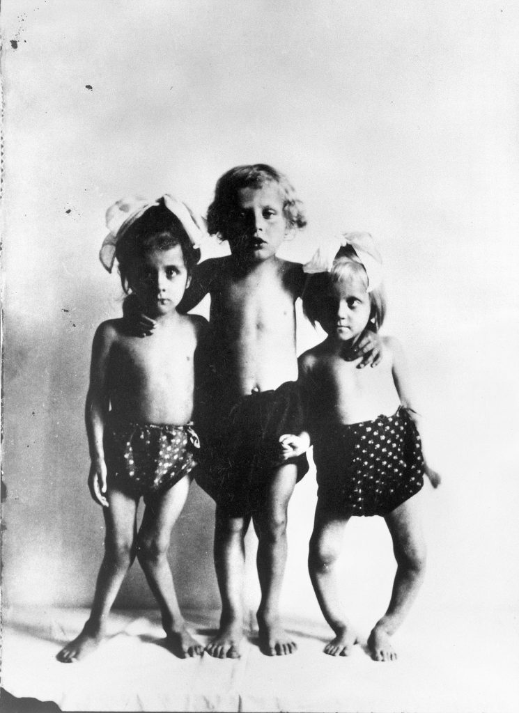 Rickets, which is brought on by vitamin D deficiency, leads to deformities in children. Three children with the disease are shown in this photo taken in Vienna, Austria (unknown date).