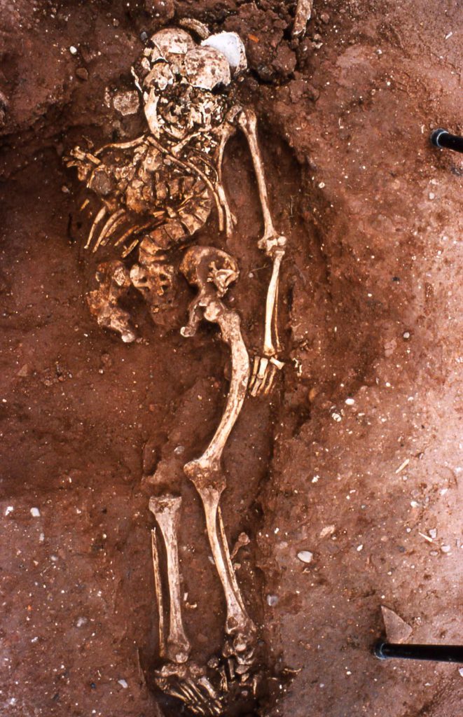 An adult skeleton from the author’s work at St. Martin’s churchyard in Birmingham displays obvious signs of childhood rickets, such as markedly bowed thigh bones.