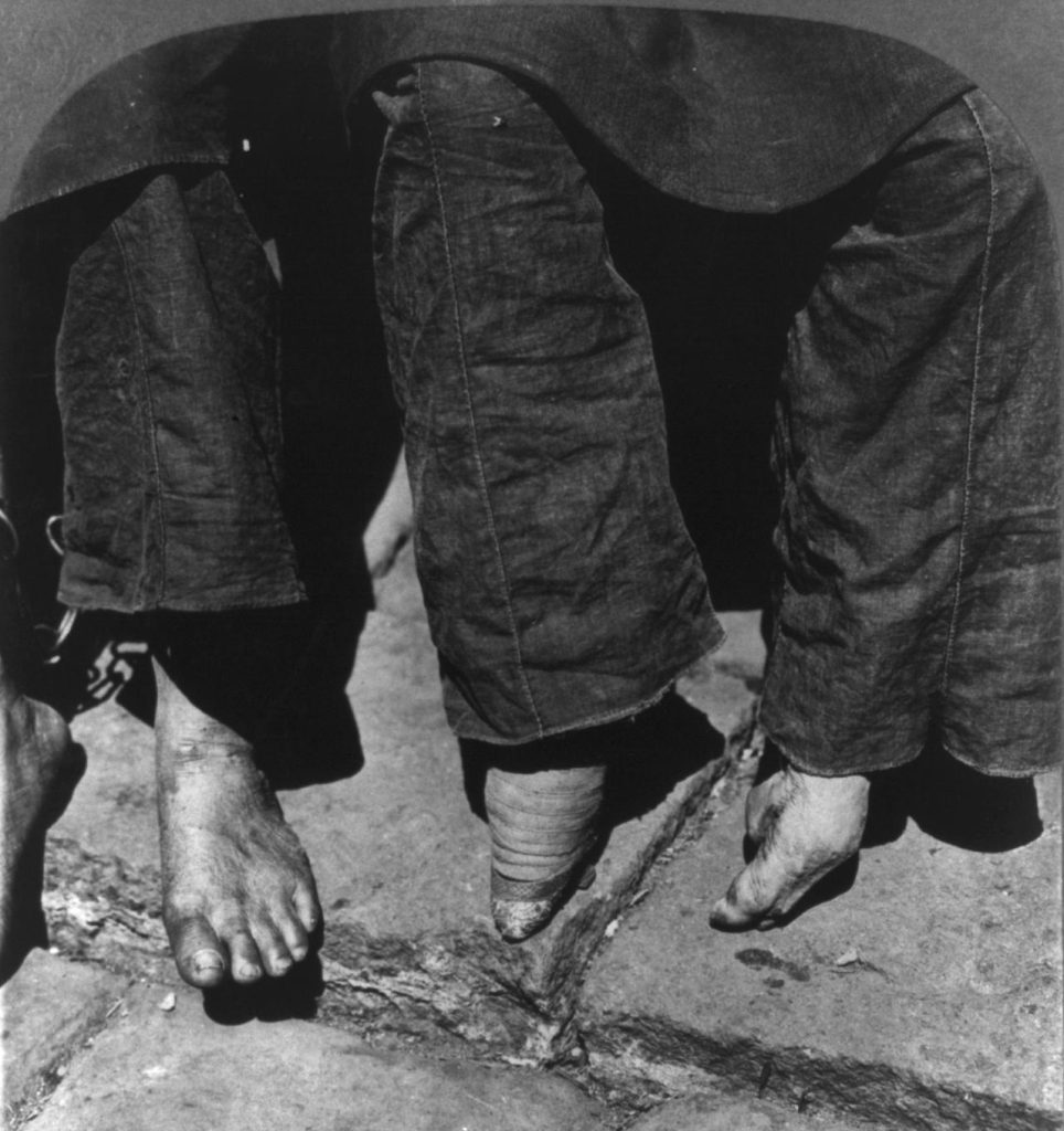 A photo from the early 1900s in China displays a woman’s feet that grew naturally (left) and the feet of a woman who had hers bound (right).