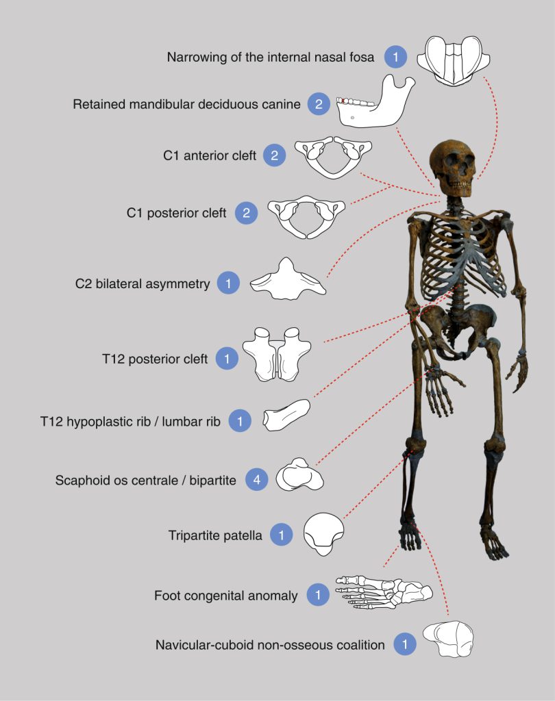 Researchers catalogued 17 congenital anomalies in a group of Neanderthals in the El Sidrón Cave in Spain. (The number of instances of each type of deformation is shown in blue.)