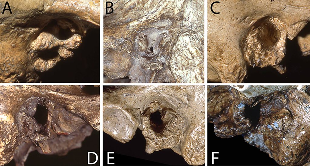 Figure Title: Examples of external auditory exostoses (EAE) among Neandertal specimens.