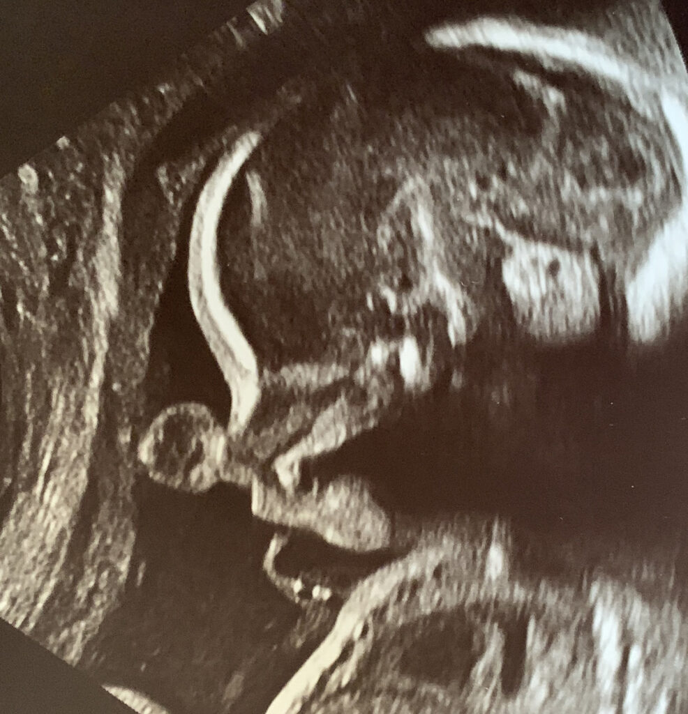 A black-and-white ultrasound image shows a human fetus.