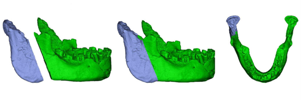 A graphic shows a row of three computer images of a jawbone. Each is shaded in blue on the left side and green on the right side. The left-most image is a cross-section profile, the center is a single profile, and the right-most is a plan view.