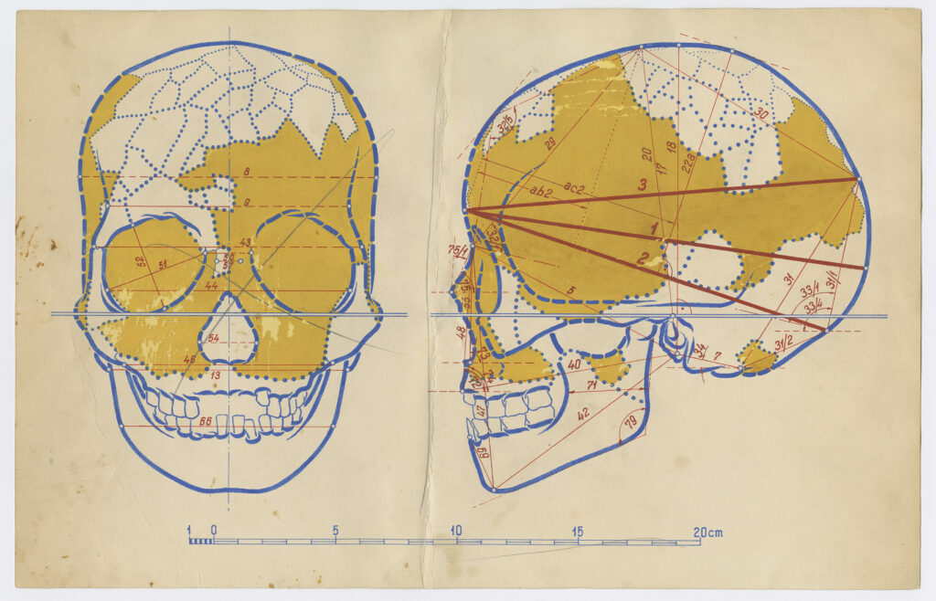 Two side-by-side graphics depict skulls, one facing forward and the other in profile. Both images are outlined in blue and have sections shaded in yellow. The profile image has three red lines spanning across it in two V shapes.
